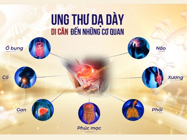 Ung thư dạ dày di căn