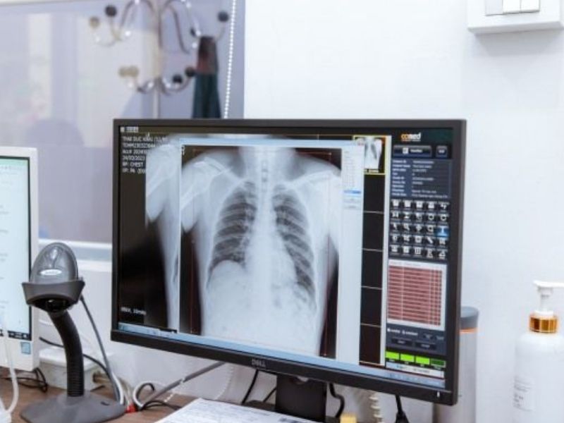 X quang phổi giúp chuẩn đoán ung thư phổi 